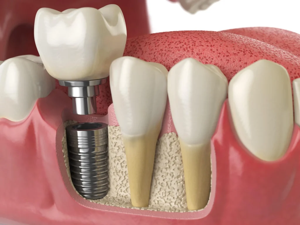 Implantate