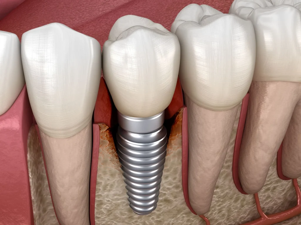 Periimplantitis