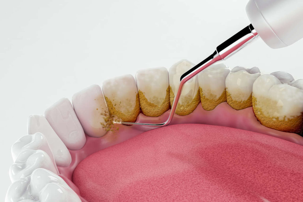 dental-cleaning-removing-plaque