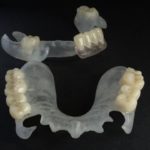 Digital Dentistry: 3D-gedruckte Prothesenbasis für Ober- und Unterkiefer im Rohzustand vor der Finalisierung.