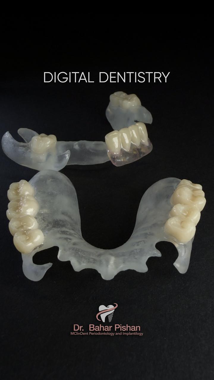 zahnersatz-aus-dem-3d-drucker-1200-wien Digital Dentistry: 3D-gedruckte Prothesenbasis für Ober- und Unterkiefer im Rohzustand vor der Finalisierung.